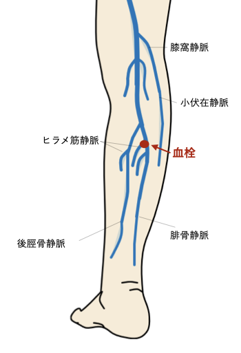 アキレス腱断裂と深部静脈血栓症：井出整形外科内科クリニック
